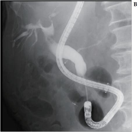 Bile Duct Drainage Using A Short Double Balloon Endoscope For A