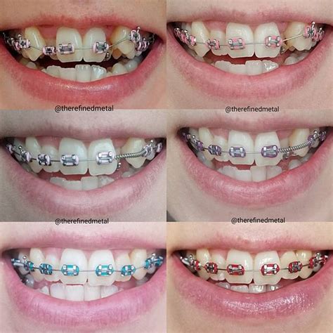 About 7 Ideas On Choosing The Best Color For Your Braces Telegraph