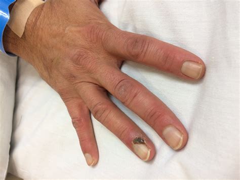 Buerger Disease (Thromboangiitis Obliterans) - Techniques in Vascular