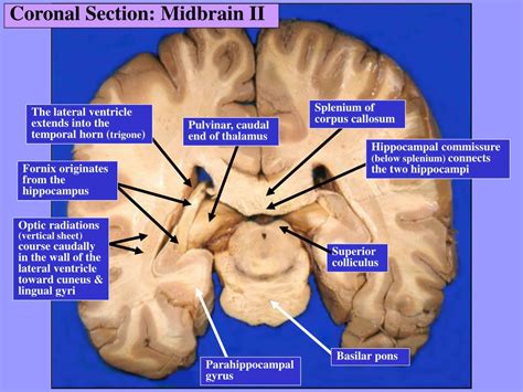 Ppt Sectional Anatomy Of The Brain Dr Gr Leichnetz Powerpoint