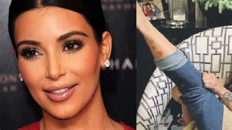 Psoriasis Kayak Kim Kardashian Kini Sudah Ada Obatnya Lifestyle