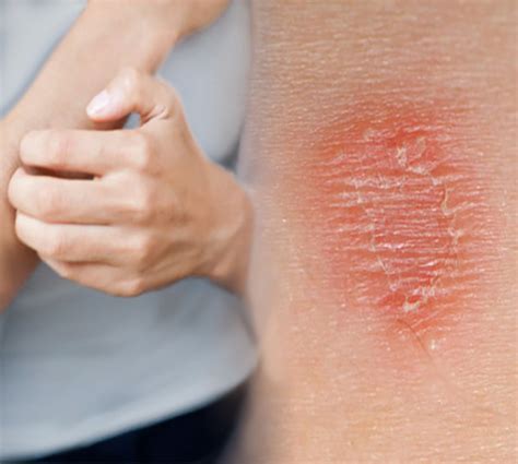 Mechanisms Driving Inflammation In Psoriasis