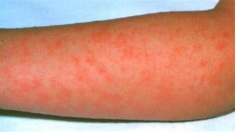 Scarlet Fever What Are The Symptoms Central Itv News