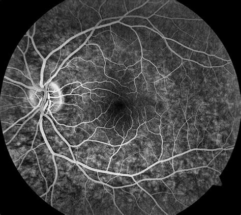 Fluorescein Angiography Baton Rouge Restore Your Vision
