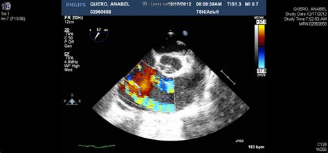 Mid Esophageal Right Ventricle Inflow Outflow View Tricuspid