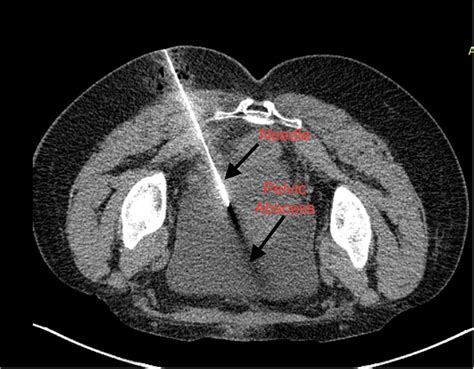 Cureus Post Caesarean Section Deep Pelvic Abscess CT Guided