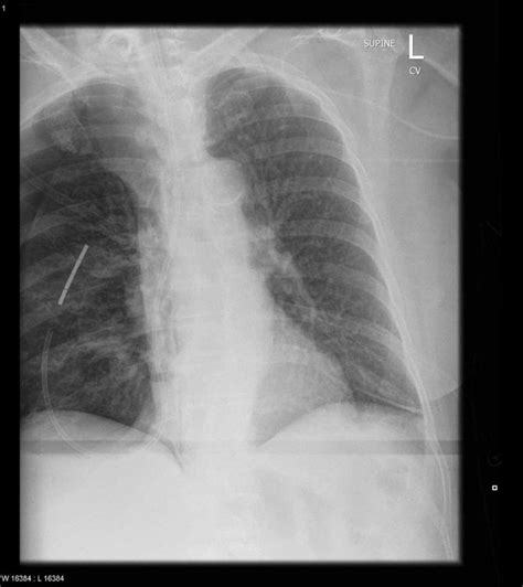 Traumatic Pneumothorax Explanation Diagnosis And Management Learn