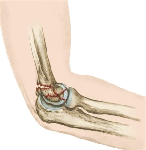 Distal Humerus Fractures Of The Elbow Orthoinfo Aaos