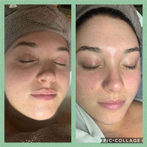 Before And After Facial Facial Skin Care Fashion