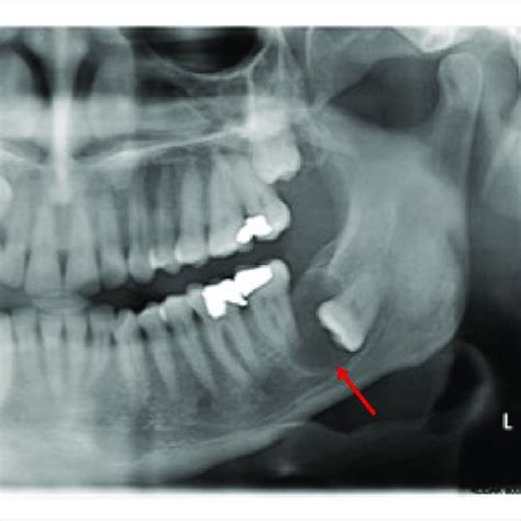 Pdf Bilateral Mandibular Dentigerous Cysts Presenting As An