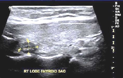 Thyroid Lymph Nodes