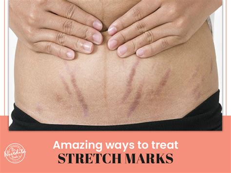 Things To Know About Stretch Marks Causes Diagnosis And Treatments