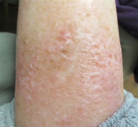 Symptoms Of Venous Stasis Dermatitis