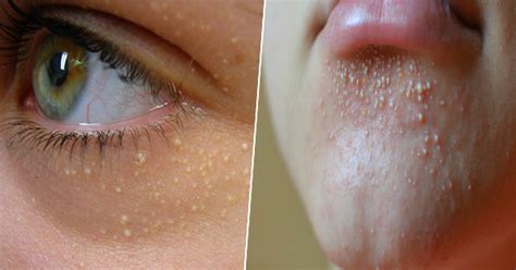 Be Aware Do You Notice Small White Bumps On Your Face The
