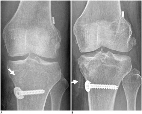 Acl Reconstruction A Tibial Fixation Screw Arrow Can Be Seen