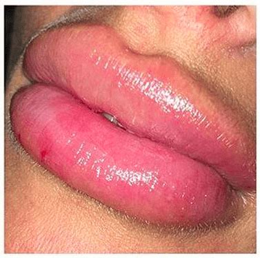 Lip Fillers Gone Wrong Dissolve Filler With Hyalase Advice Cost