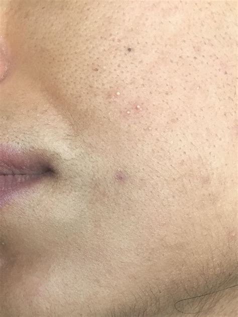 Pimple Like Bumps On Face