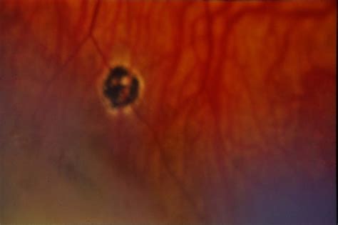 Presumed Ocular Histoplasmosis Syndrome Retina Image Bank