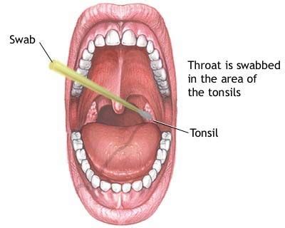 Lumps that come and go are not usually due to cancer. throat cancer info: signs of throat cancer