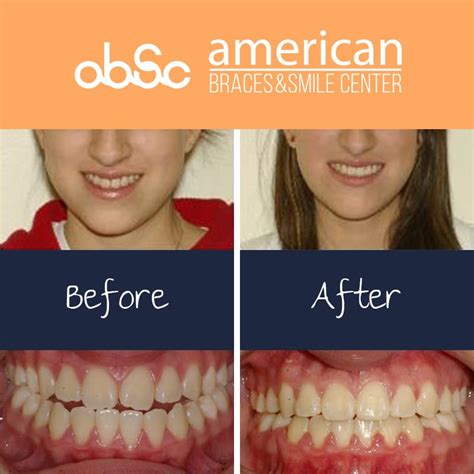 Before And After Braces Pics Orthodontic Treatment Absc