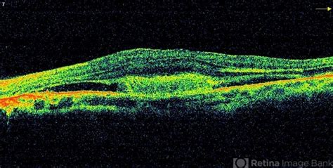 Angioid Streaks With Cnvm Oct Le Retina Image Bank