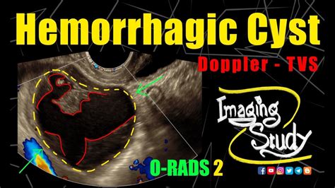 Hemorrhagic Ovarian Cyst O Rads Us 2 Tvs Doppler Ultrasound
