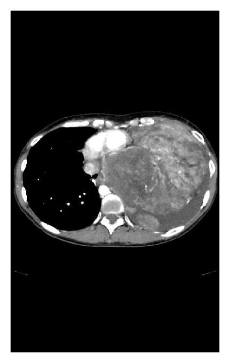 A Chest Contrast Enhanced Computed Tomography Ct Before Treatment