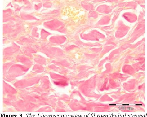 Figure From Giant Fibroepithelial Polyp Of Vulva A Case Report And