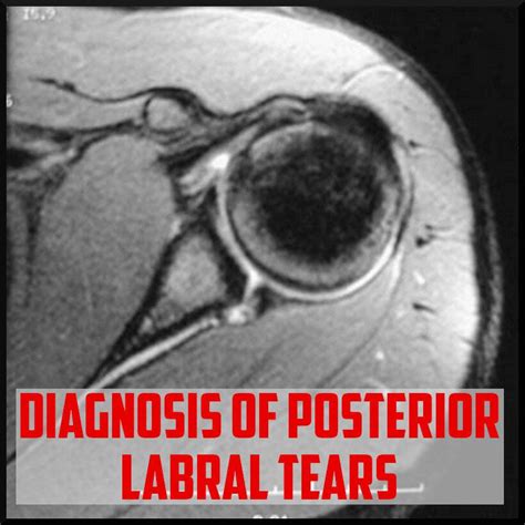 Diagnosing Posterior Labral Tears Sports Medicine Review