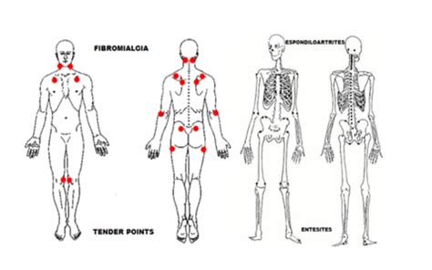 Muitas dúvidas sobre os pontos de dor, quais são os pontos da fibromialgia, onde ficam. Fibromialgia Pontos / Pontos da fibromialgia: entenda os ...