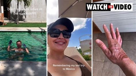 Viral Tiktok Shows Womans Margarita Dermatitis From Mexico Au — Australias Leading
