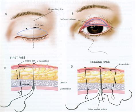 Eyelid Surgery By Prof Dr Cn Chua 蔡鐘能 Different Suture Techniques For