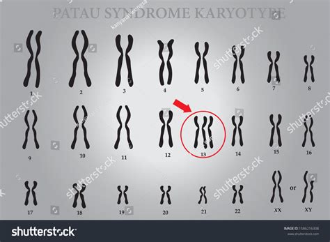 Patau Syndrome Karyotype One Chromosomal Disorders เวกเตอรสตอก ปลอด