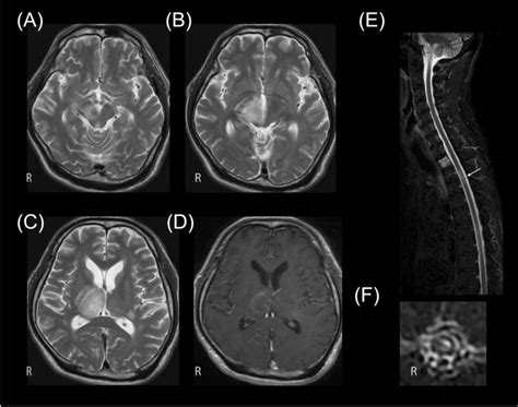 Transaxial Brain Magnetic Resonance Imaging Mri 1 Month After
