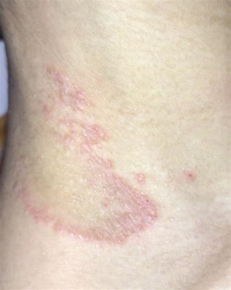 Please Help Me Identify What This Rash On My Neck Is Caused By It Has