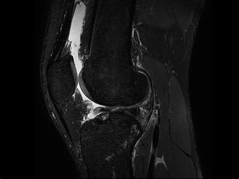 Smartspeed Traumatic Knee Imaging Philips Mr Body Map