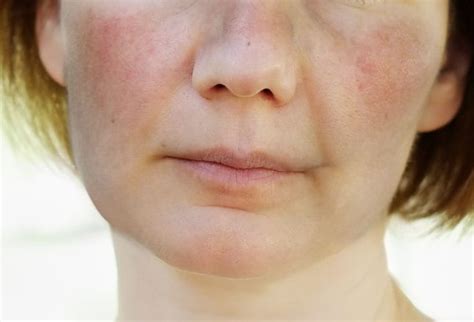 Systemic Lupus Erythematosus Diverse And Difficult To Diagnose