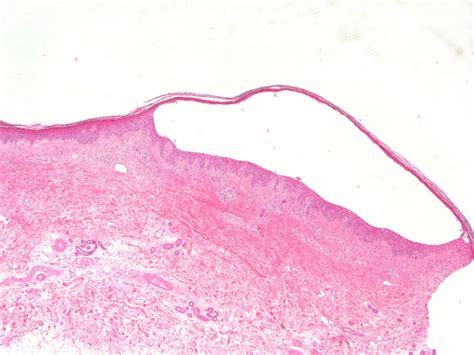 Bullous Pemphigoid Like Skin Eruption During Treatment With Rivaroxaban