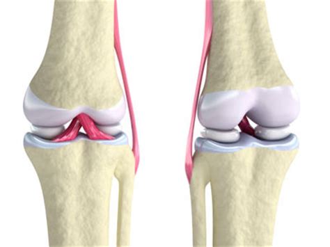 How to sleep comfortably after meniscus surgery. knee meniscus tear brampton, physiotherapy brampton