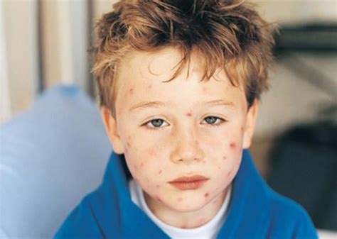 Visual Guide To Childrens Rashes And Skin Conditions Rashes In