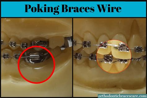 Poking Braces Wire Why This Happens How To Fix Orthodontic Braces Care