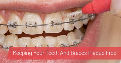 However, the duration of brushing and mechanics of using an electric toothbrush are. How To Get Rid Of Plaque While Wearing Braces | David ...