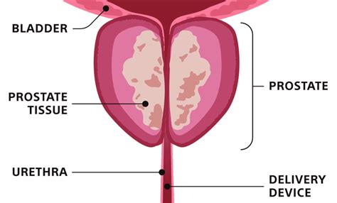 Bph Vapor Therapy With Rez M Steam Treatment For Bph