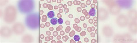 Chronic Leukemia Facts Cardiovascular Disorders And Diseases Articles
