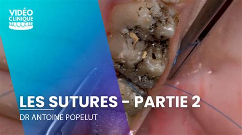 Les Sutures En 9 Points Partie 2 French Tooth