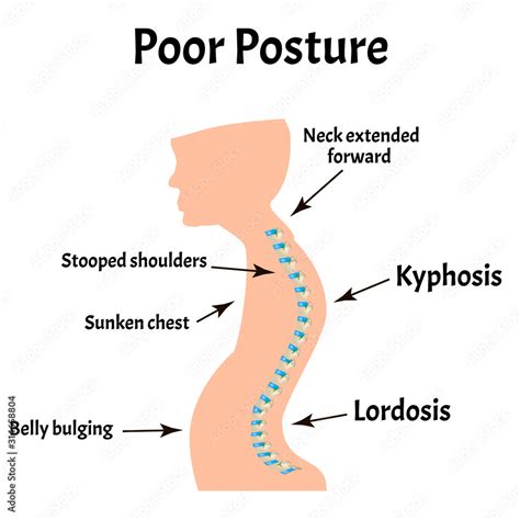 Kyphosis Lordosis Scoliosis Tema 1 Hot Sex Picture