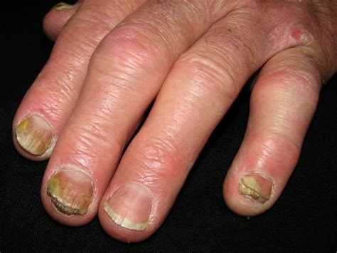 Psoriatic Arthritis Nails Signs Treatment And Photos