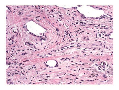 A Histopathologic Exam Of The Small Bowel Revealed The Diagnosis Of