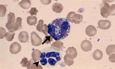 Eosinophils Cells And Smears
