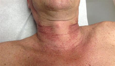 Derm Dx Red Patches On The Neck Clinical Advisor